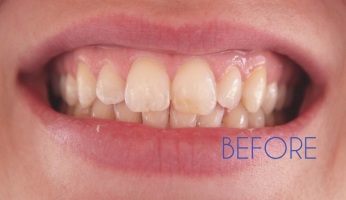 teeth whitening before